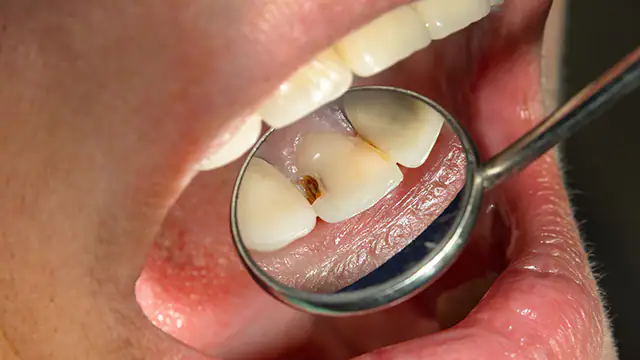 caries dental barcelona 2024
