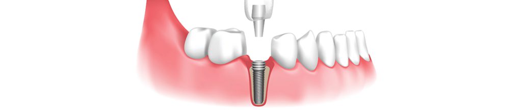 implante dental barcelona 2025